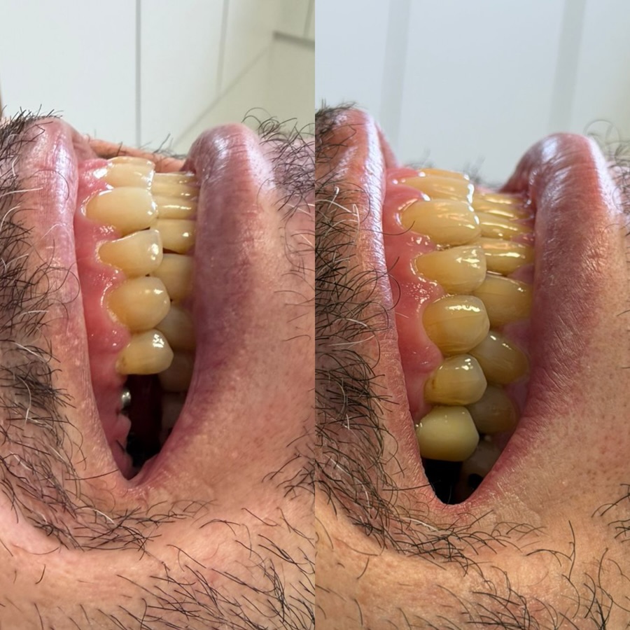 Reconstrução e Estética — antes e depois